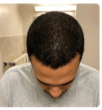 Diffused thinning, after