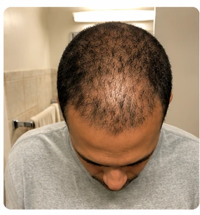 Diffused thinning, before