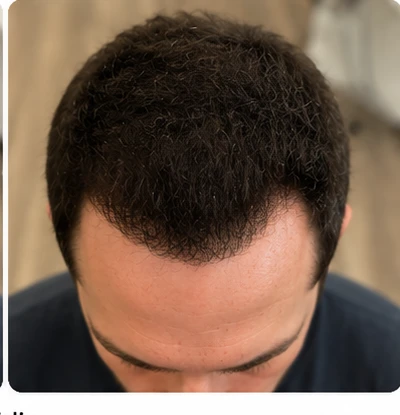 Hairline, after