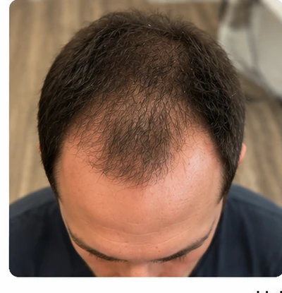 Hairline, before